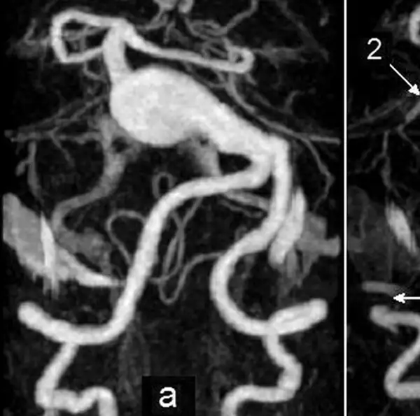 CE MR Angiography Circle Of Willis